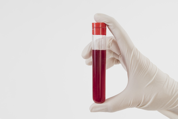 Como é realizado o Exame de Hemoglobina Glicosilada?